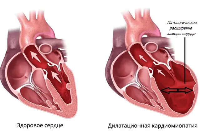 Дилатационная кардиомиопатия о собак